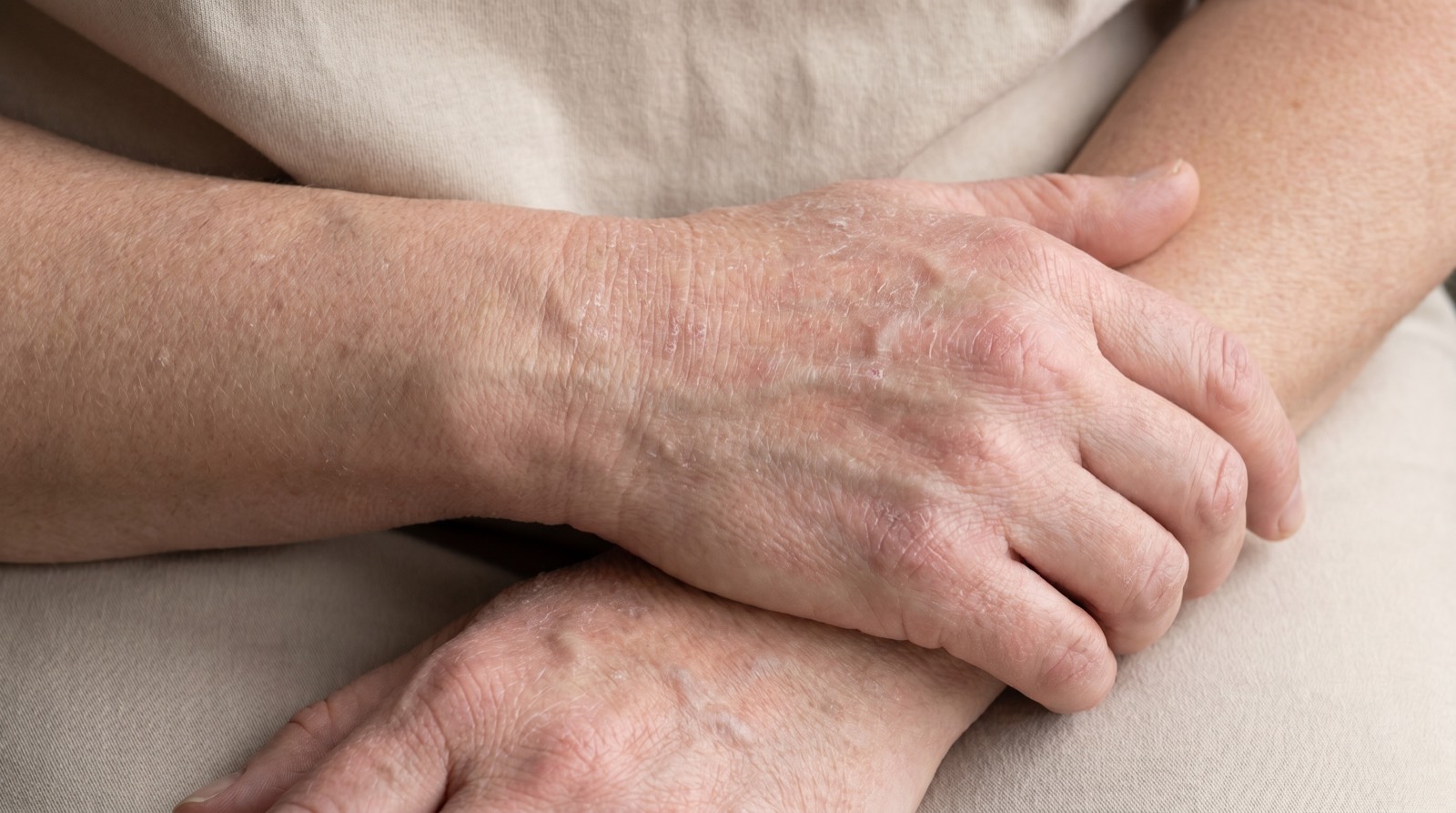 Close-up das mãos de um adulto com pele seca, descamada e levemente irritada